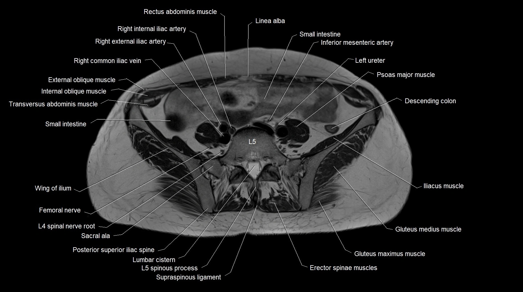 MRI 3T pelvis axial cross section anatomy image 6.webp